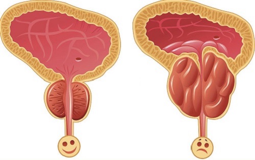 Простатит